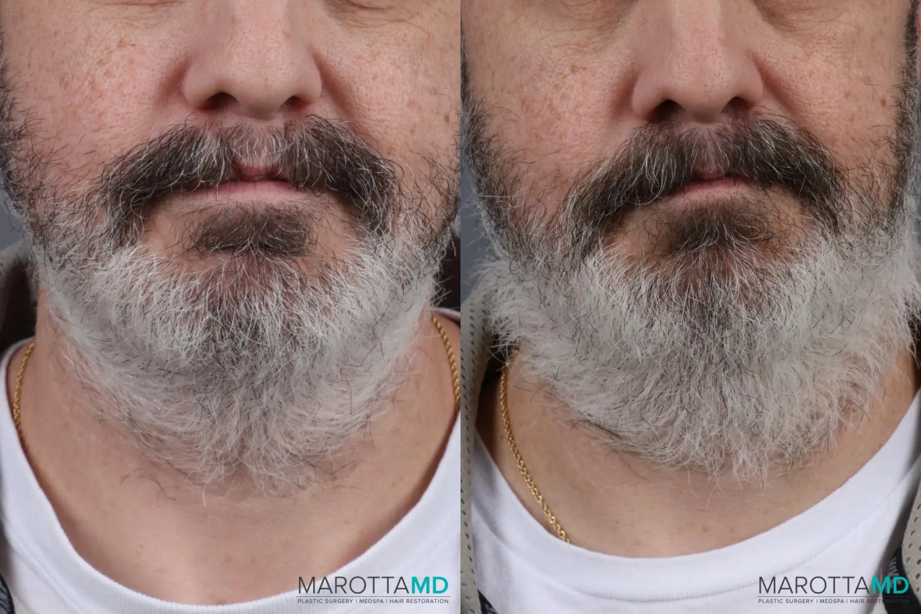 Hair Transplantation: Patient 7 - Before and After  