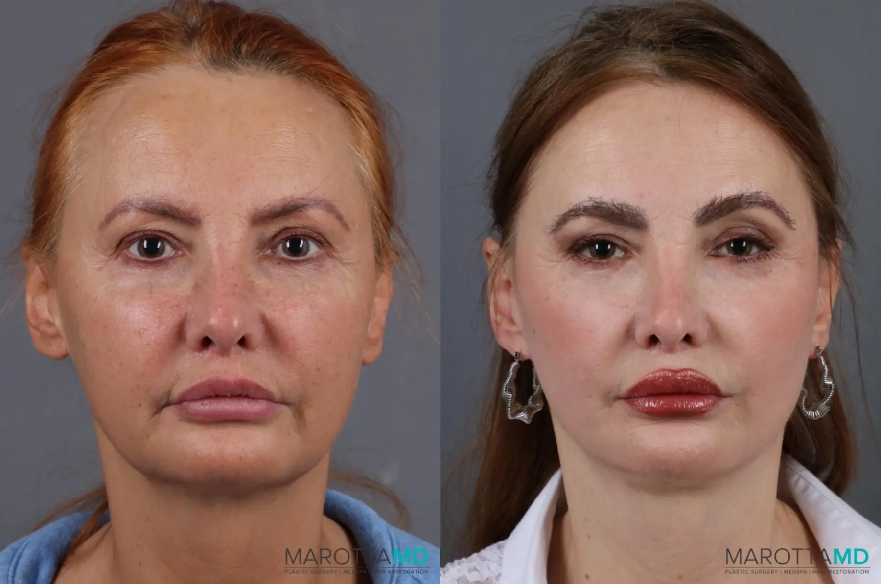 Hair Transplantation: Patient 6 - Before and After  