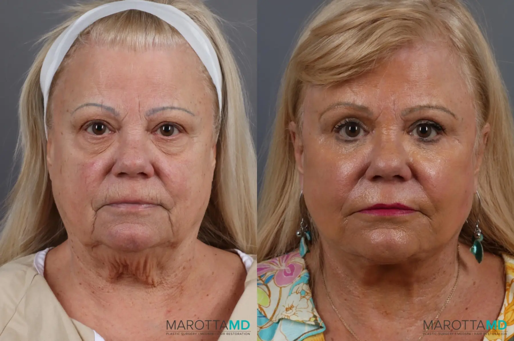 Laser Skin Resurfacing - Face: Patient 6 - Before and After  