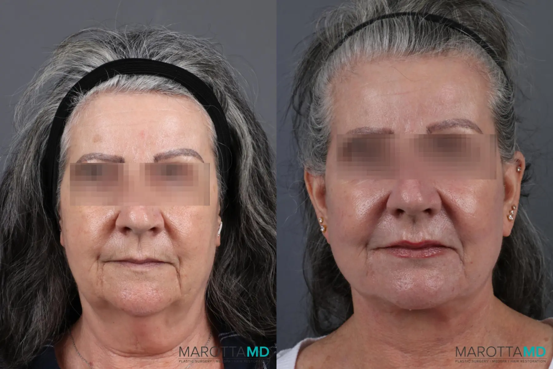 Laser Skin Resurfacing - Face: Patient 5 - Before and After  