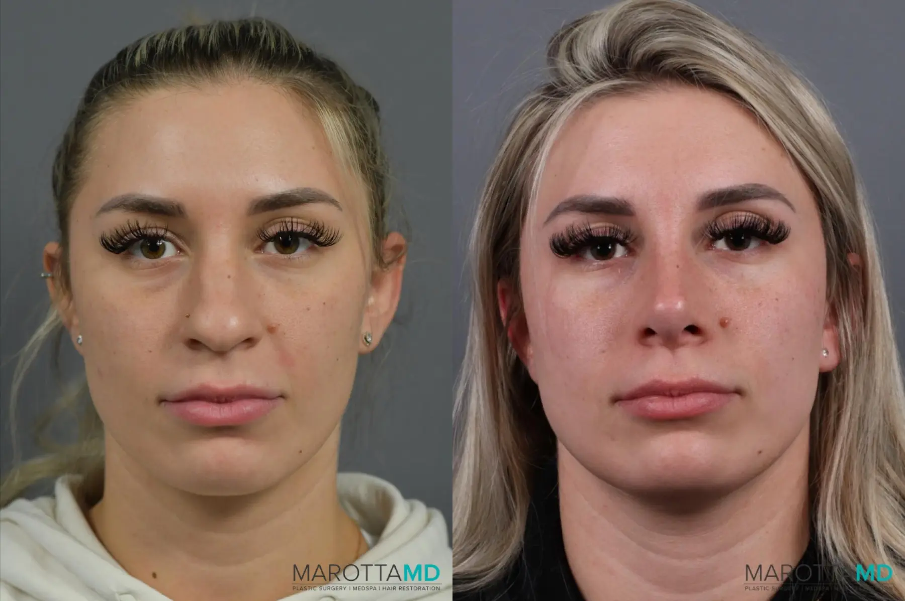 Rhinoplasty: Patient 5 - Before and After  