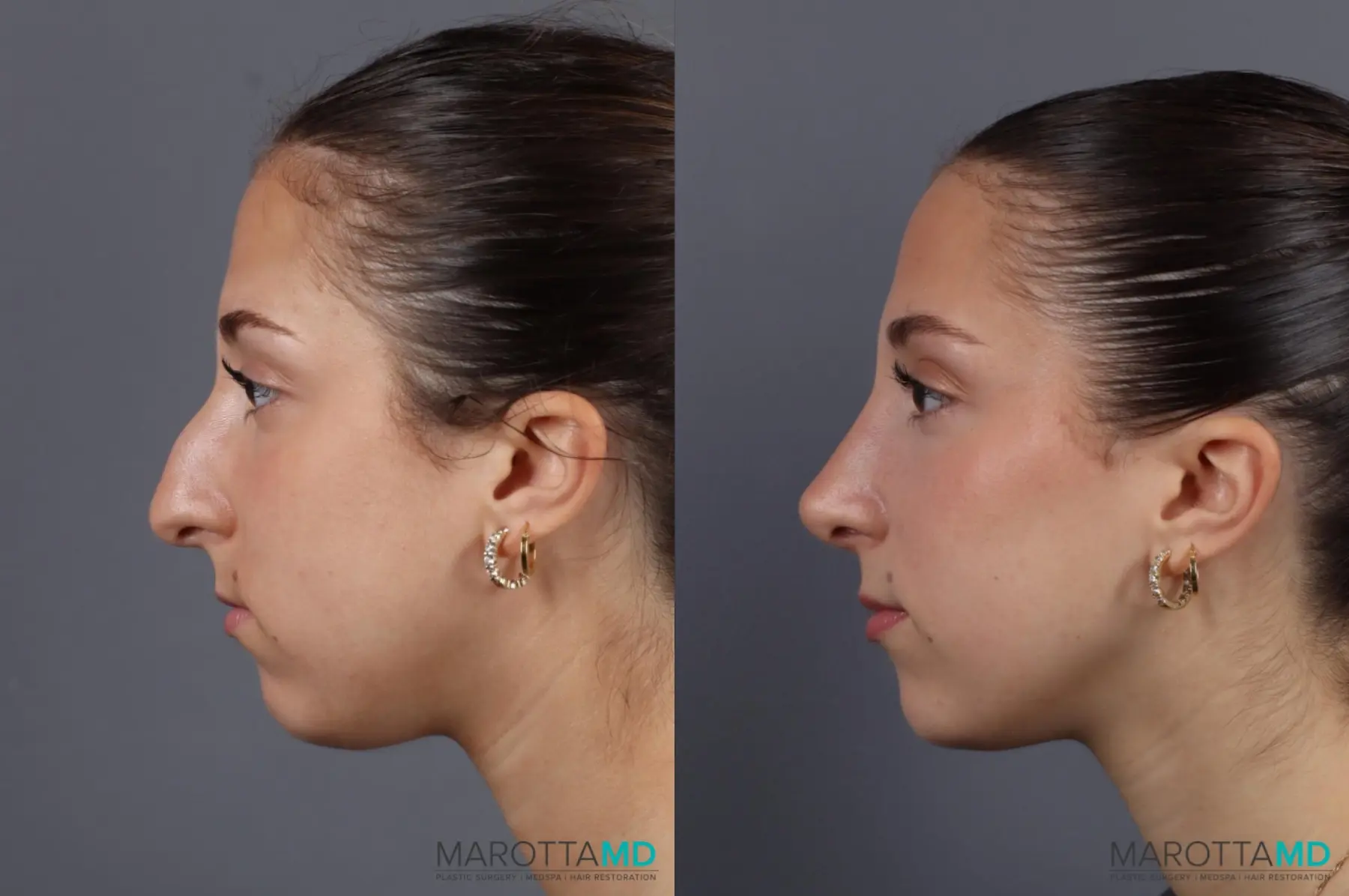 Rhinoplasty: Patient 9 - Before and After  