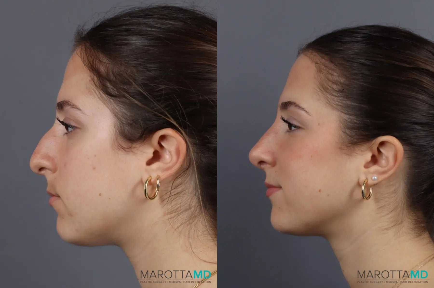 Rhinoplasty: Patient 8 - Before and After  