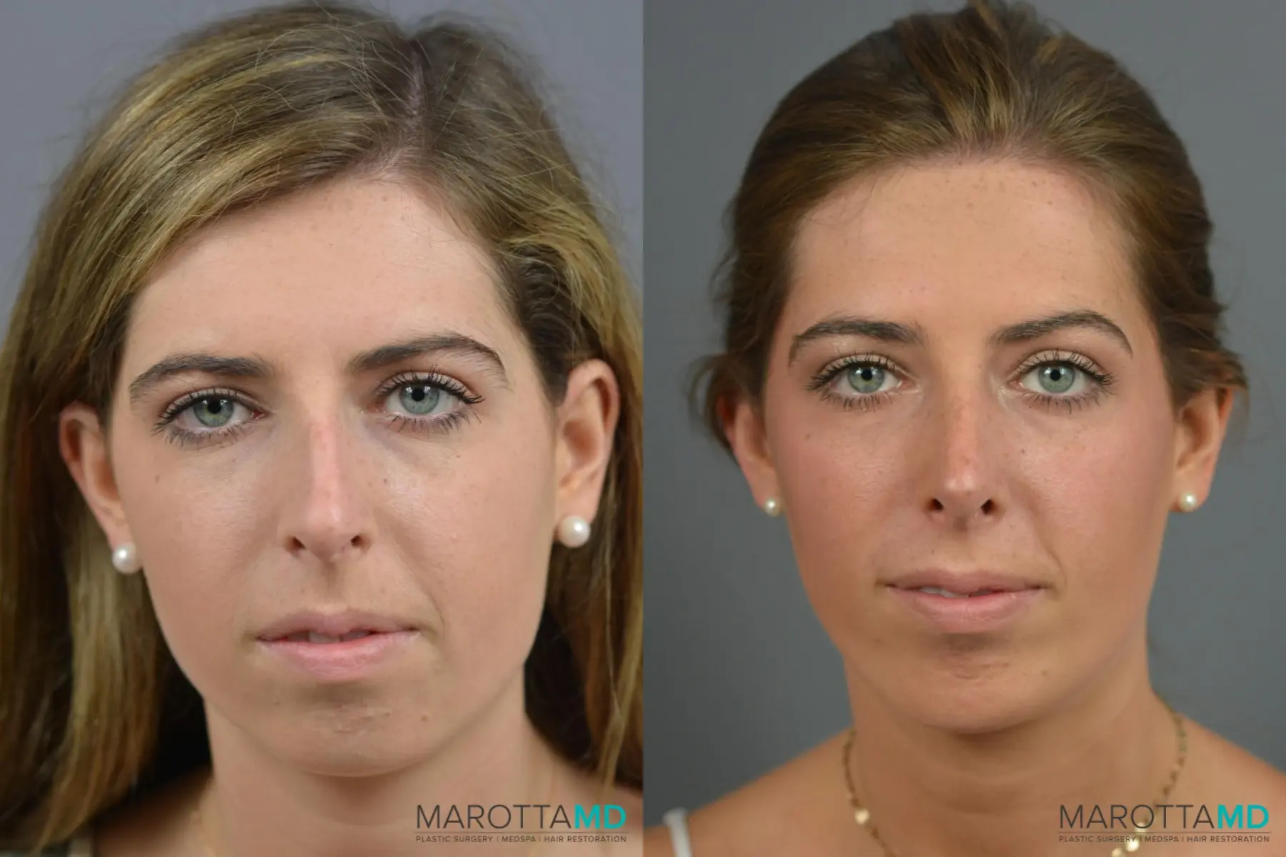 Rhinoplasty: Patient 7 - Before and After  