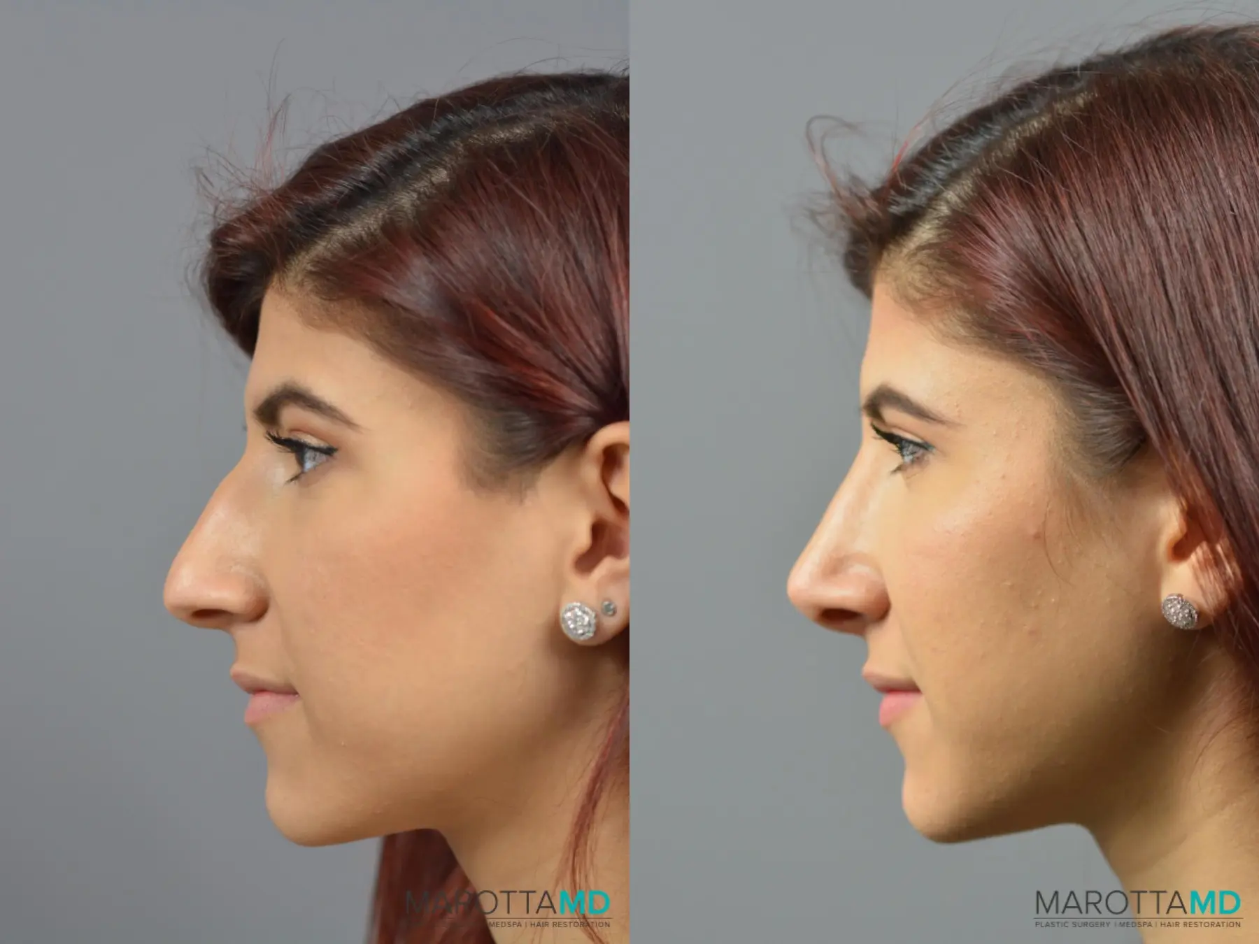 Rhinoplasty: Patient 6 - Before and After  