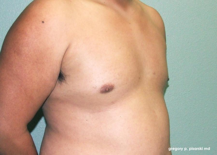 Gynecomastia: Patient 3 - After 2