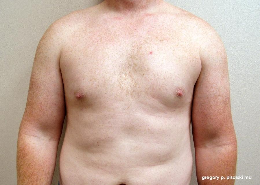 Gynecomastia: Patient 5 - After  