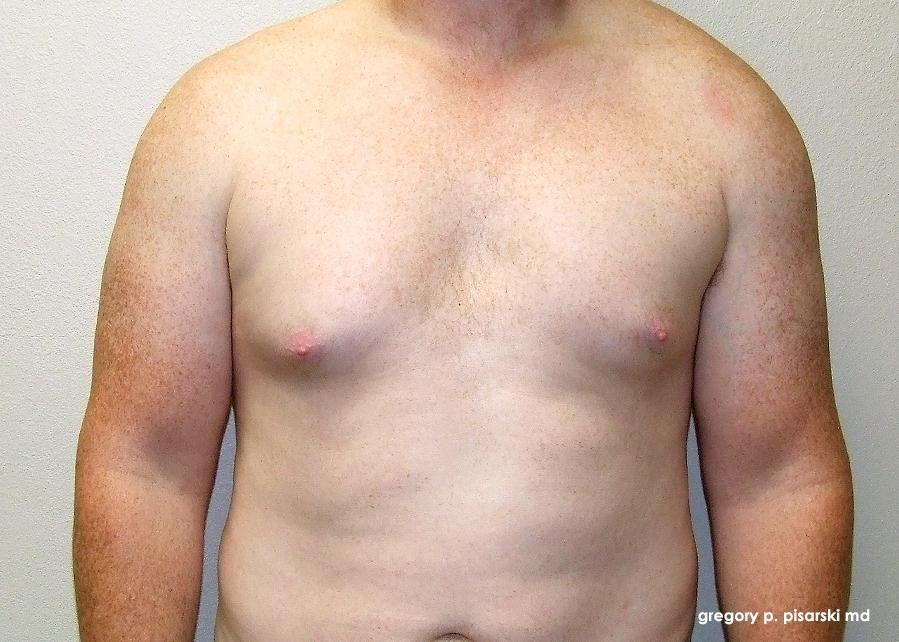 Gynecomastia: Patient 5 - Before 