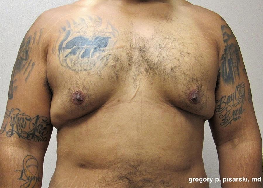 Gynecomastia: Patient 6 - Before 