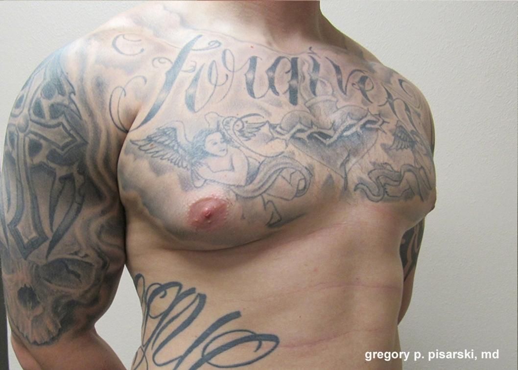 Gynecomastia: Patient 7 - Before and After 2