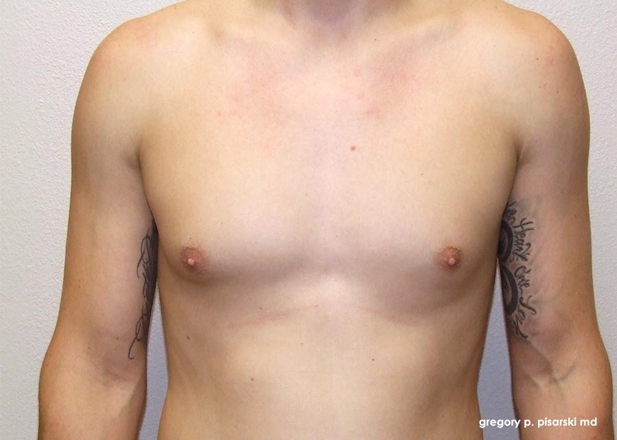 Gynecomastia: Patient 4 - Before 