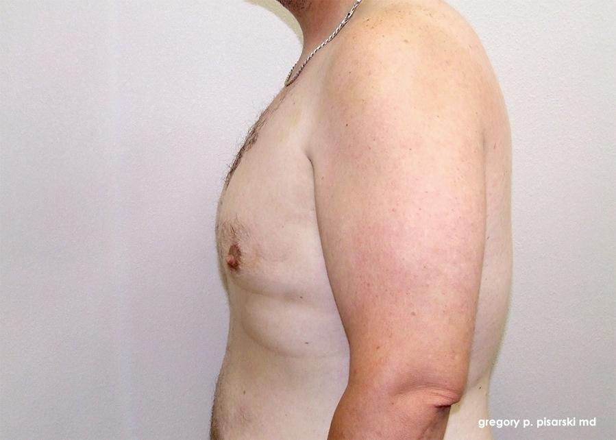 Gynecomastia: Patient 8 - After  