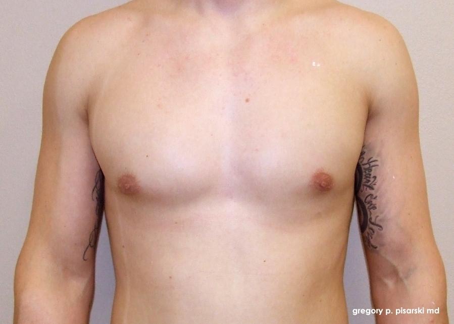 Gynecomastia: Patient 4 - After  