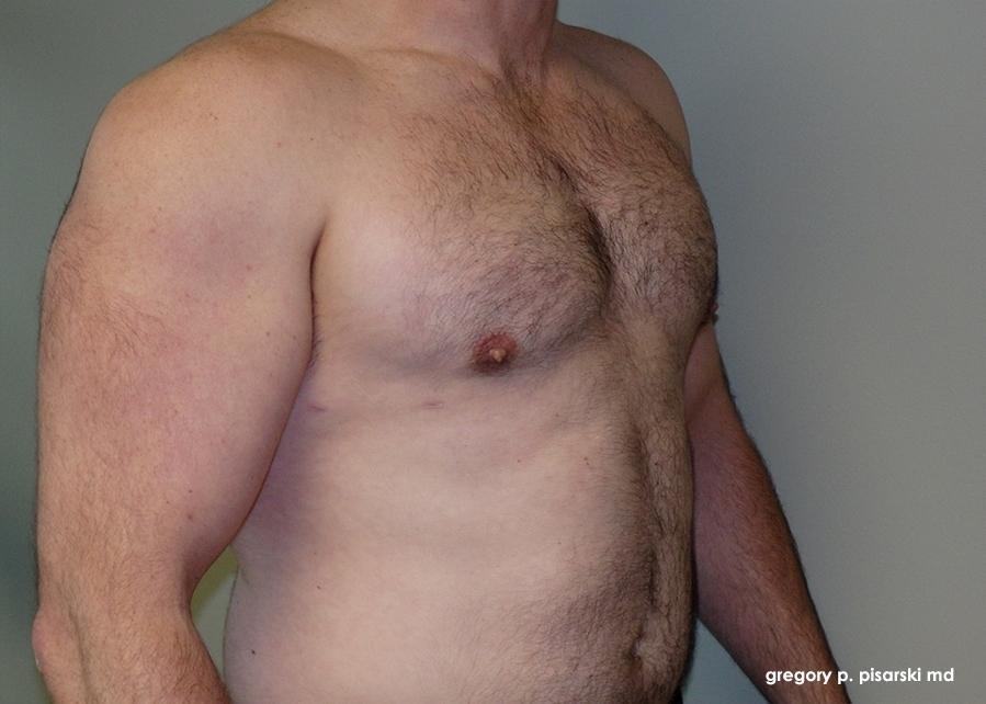 Gynecomastia: Patient 1 - After 2
