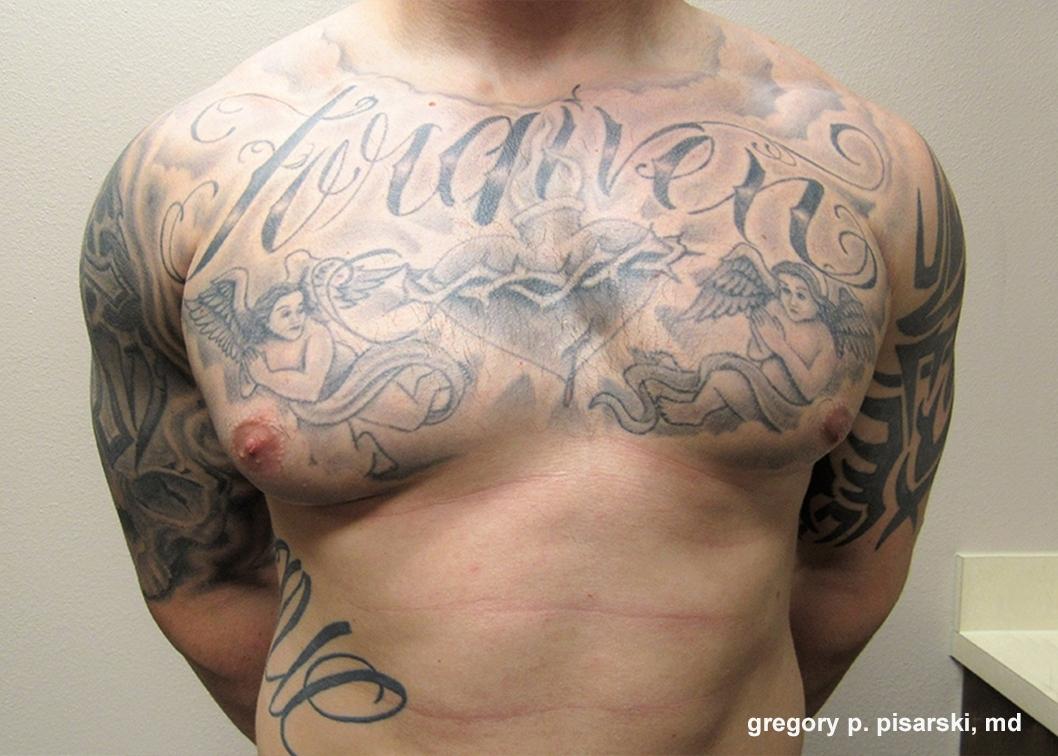 Gynecomastia: Patient 7 - Before 
