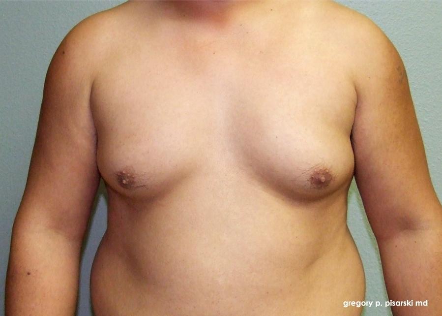 Gynecomastia: Patient 3 - Before 