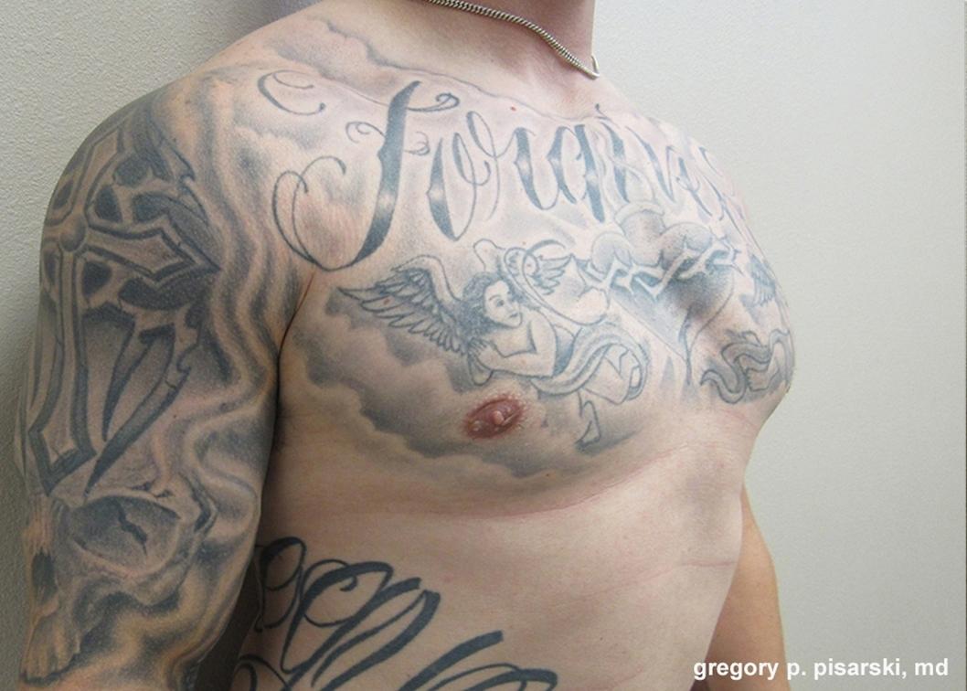 Gynecomastia: Patient 7 - After 2