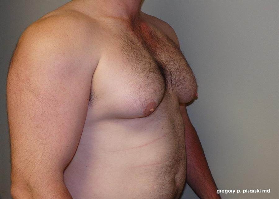 Gynecomastia: Patient 1 - Before and After 2