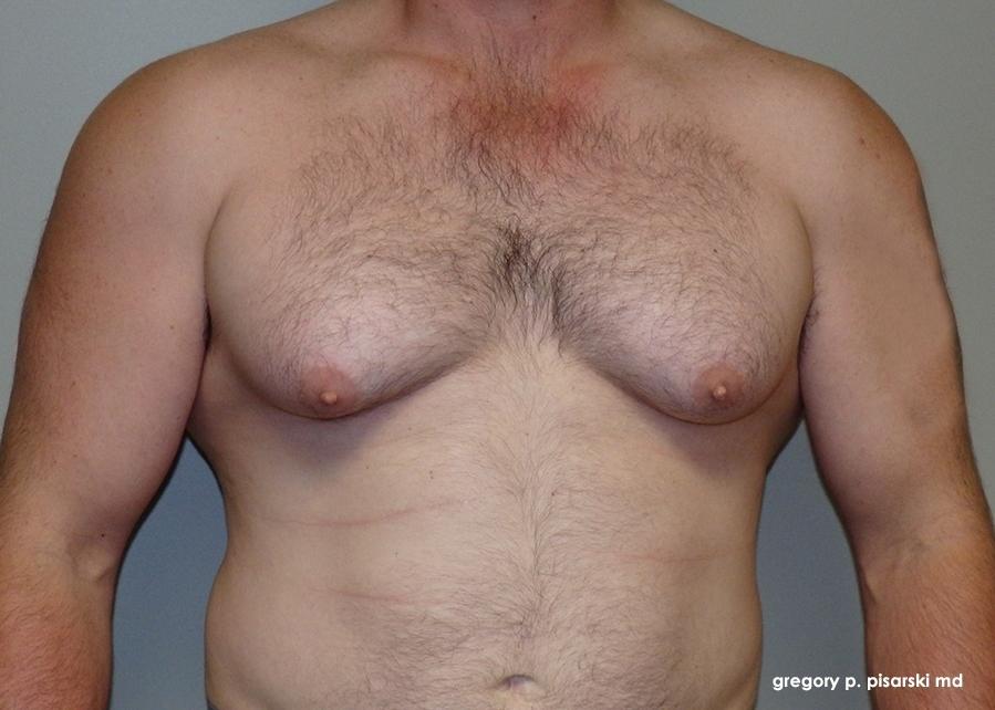Gynecomastia: Patient 1 - Before 