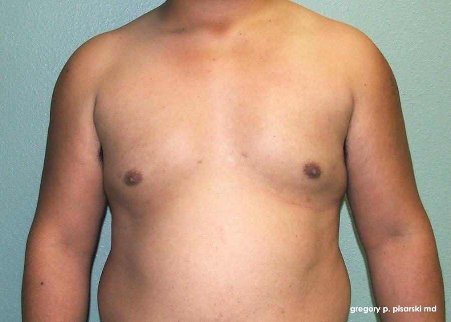 Gynecomastia: Patient 3 - After  