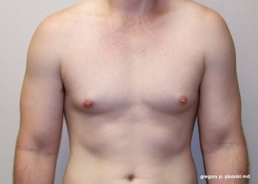 Gynecomastia: Patient 2 - Before 