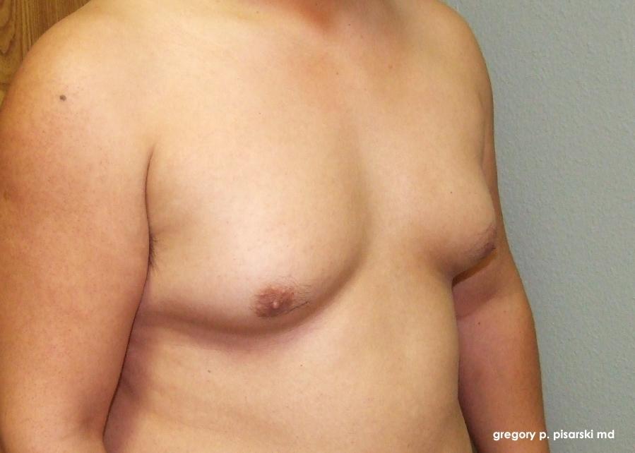 Gynecomastia: Patient 3 - Before and After 2