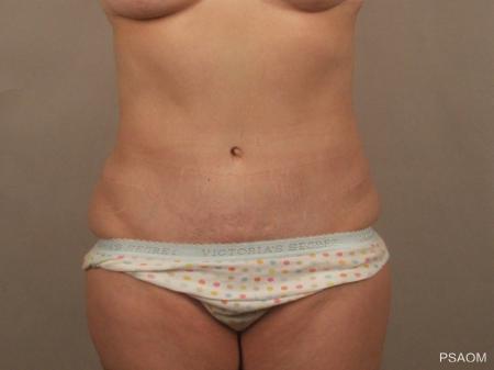 Tummy Tuck: Patient 5 - After Image