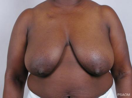 Breast Reconstruction: Patient 1 - Before Image