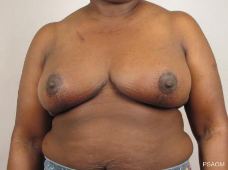 Breast Reconstruction: Patient 1 - After Image
