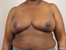 Breast Reconstruction: Patient 1 - After Image
