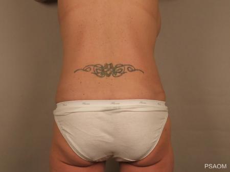 Liposuction: Patient 3 - After Image 3