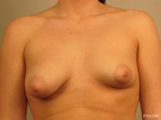 Breast Augmentation: Patient 5 - Before Image