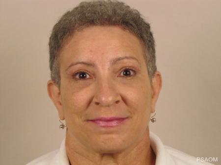 Eyelid Lift: Patient 1 - After Image