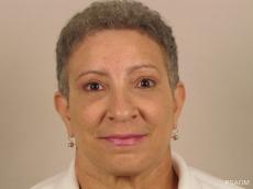 Eyelid Lift: Patient 1 - After Image