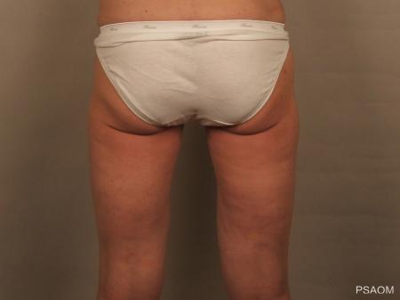 Liposuction: Patient 3 - After Image 2