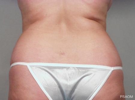 Liposuction: Patient 2 - Before Image 1