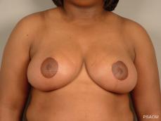 Breast Reduction: Patient 10 - After Image