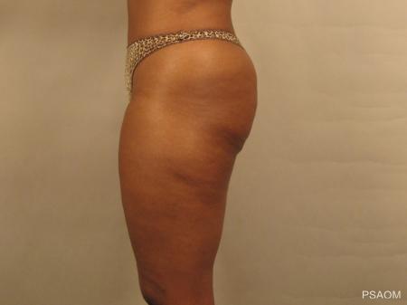 Liposuction: Patient 1 - Before Image 2