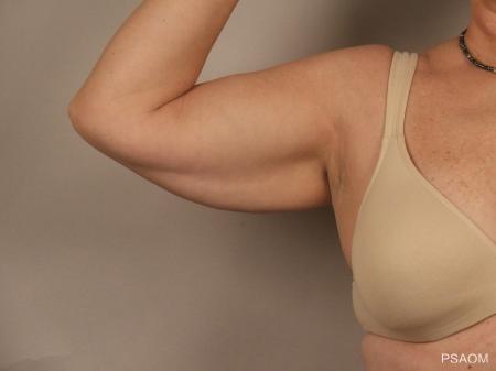 Arm Lift: Patient 1 - Before and After Image 3