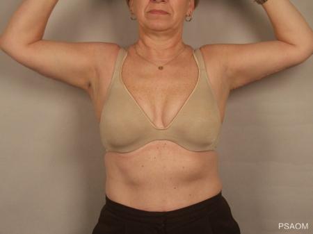 Arm Lift: Patient 1 - After Image 1