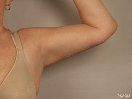 Arm Lift: Patient 1 - After Image 2