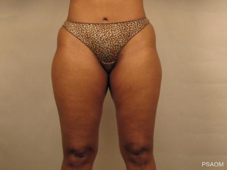 Liposuction: Patient 1 - Before Image