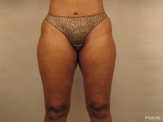 Liposuction: Patient 1 - Before Image