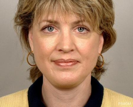 Facelift: Patient 1 - After Image