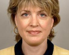 Facelift: Patient 1 - After Image
