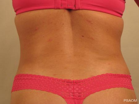 Liposuction: Patient 4 - After Image