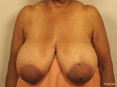 Breast Reduction: Patient 1 - Before Image
