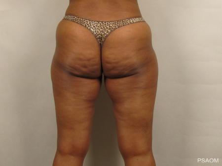 Liposuction: Patient 1 - Before and After Image 3