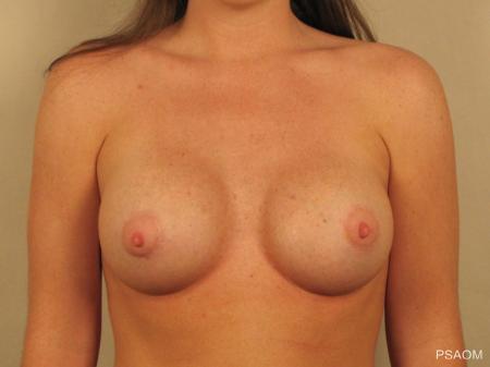 Breast Augmentation: Patient 7 - After Image