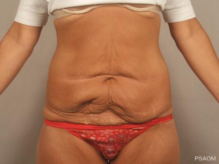 Tummy Tuck: Patient 4 - Before Image
